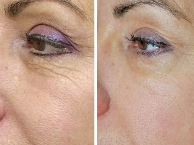 Champ laser avant et après